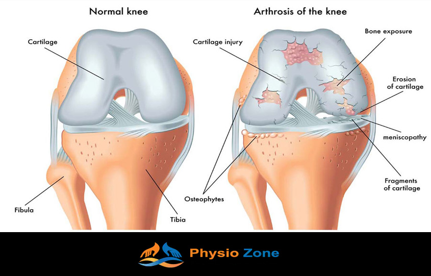 How can physiotherapy help osteoarthritis