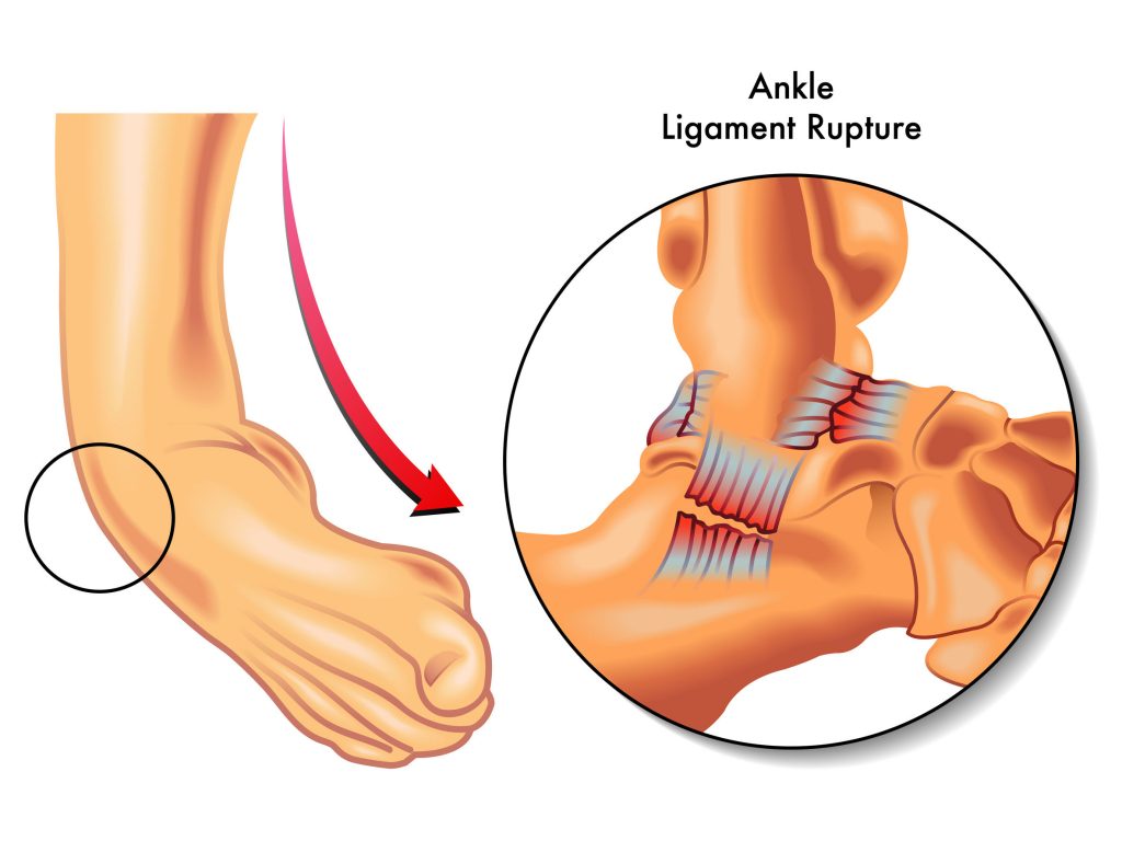 Ankle Sprain Recovery