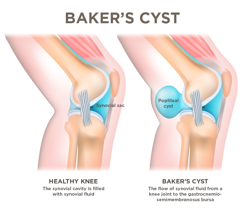 Baker’s Cyst Knee