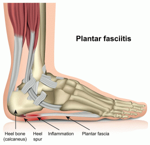 plantar fasciitis Pain