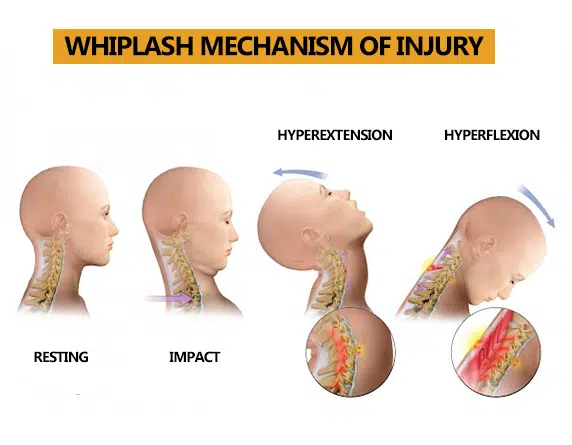 Whiplash Injury