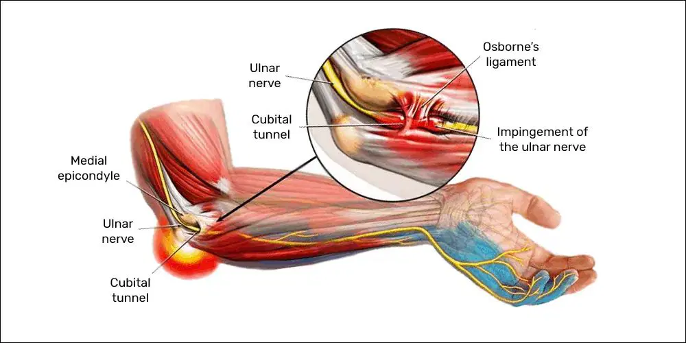 cubital tunnel syndrome