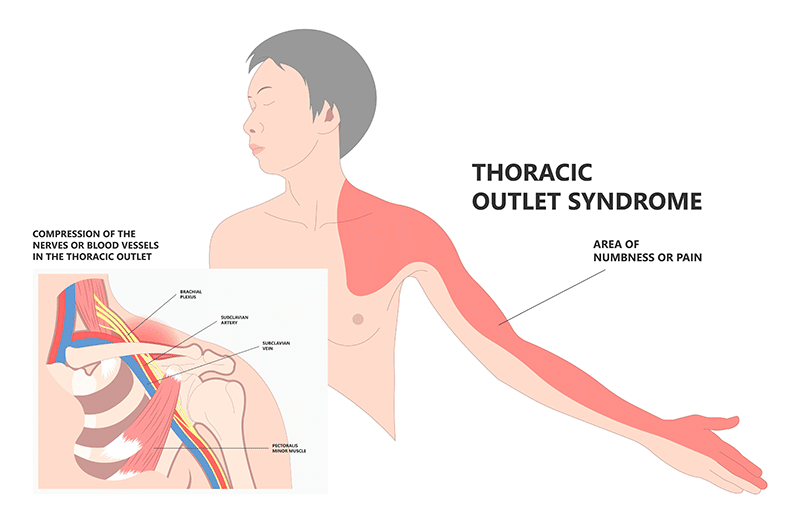 thoracic outlet syndrome